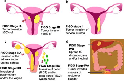 Illustrated FIGO staging system for endometrial cancer. a Stage 1 ...