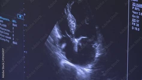 Medical ultrasound scan heart Echocardiogram shows views of valsalva ...