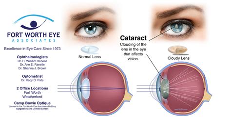 Cataract Surgery Procedure: Safety, Recovery, and Effects