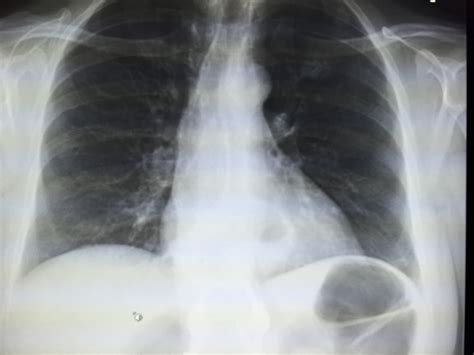 Subsegmetal Atelectasis On Chest X-Ray – Radiology In Plain English