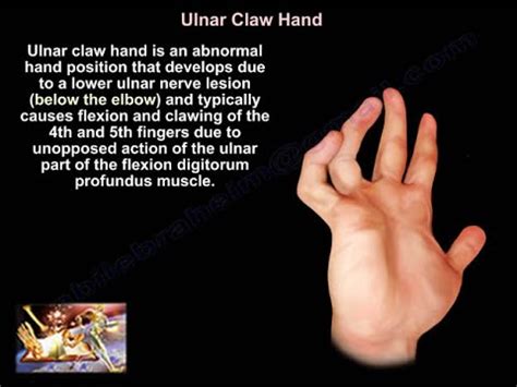 Ulnar Paradox