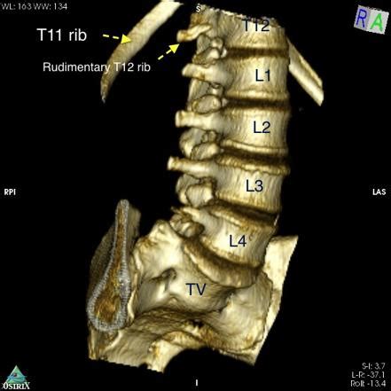 Transitional Anatomy Lumbar Spine - Human Anatomy