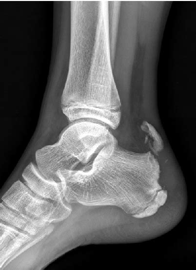 Figure 1 from Avulsion Fracture of Calcaneal Apophysis in an Adolescent ...