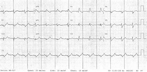 Bifascicular Block • LITFL • ECG Library Diagnosis