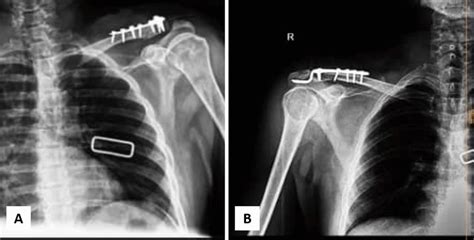 Distal clavicle fracture fixation using A T-plate and B hook plate ...