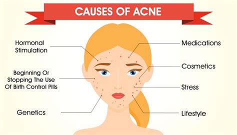 What is Acne: acne definition, causes and what makes it worse?