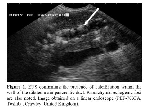 Endoscopic Ultrasound Reliably Identifies Chronic Pancreatitis when ...