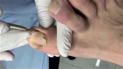 Ingrown Toenail, Removal, #1 - YouTube