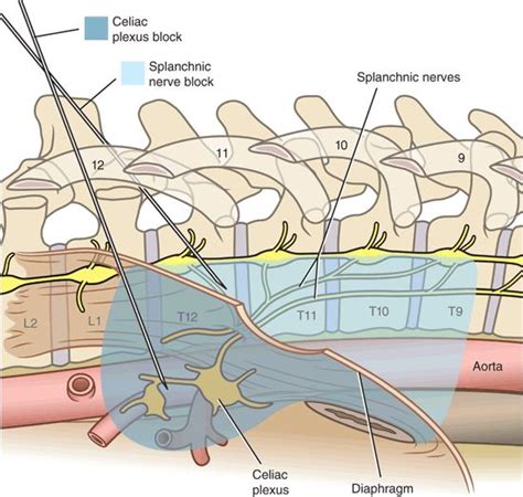 Complications Associated with Neurolytic Celiac Plexus Block ...