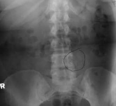 Osteoblastoma: Practice Essentials, Anatomy, Pathophysiology and Etiology