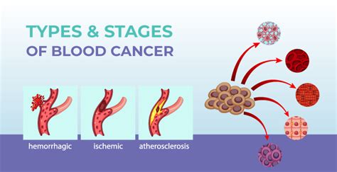 How Many Stages Are There In Blood Cancer? 2024