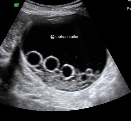 SONO DIGEST: ULTRASOUND IN HYDATID DISEASE