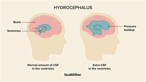 Hydrocephalus Baby Signs