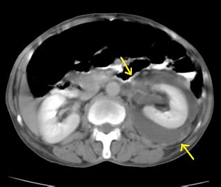 Perinephric Abscess-CT - Sumer's Radiology Blog