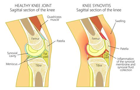 Synovitis of the Knee | Joint Inflammation | Orthopedic Knee Specialist ...