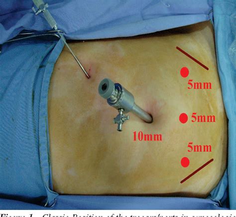 [PDF] How do I treat Ovarian Dermoid Cyst by Laparoscopy ? | Semantic ...