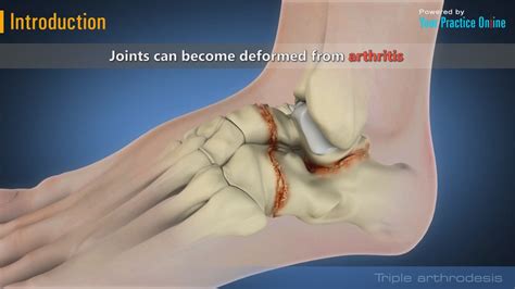 Video of Triple Arthrodesis Surgery | Foot Arthrodesis