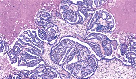 Molecular Characterization of Choroid Plexus Tumors | Children's Brain ...