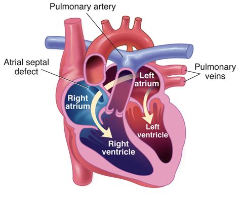 Atrial Septal Defect (ASD): Symptoms, Causes And Treatment, 60% OFF