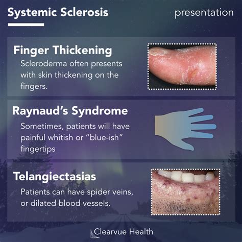 Systemic Scleroderma Hands