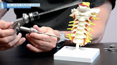 What does Minimally Invasive Spine Surgery (MISS) Mean? - Dr. Tony Mork