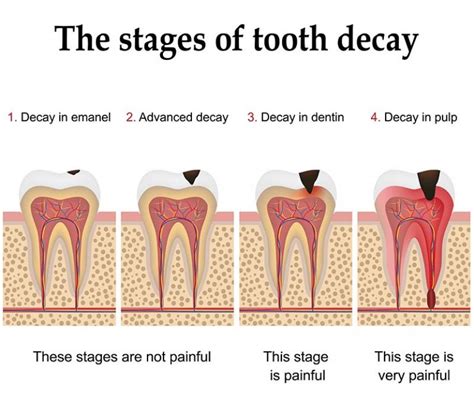 Stages-of-Tooth-Decay - South Gables Dental