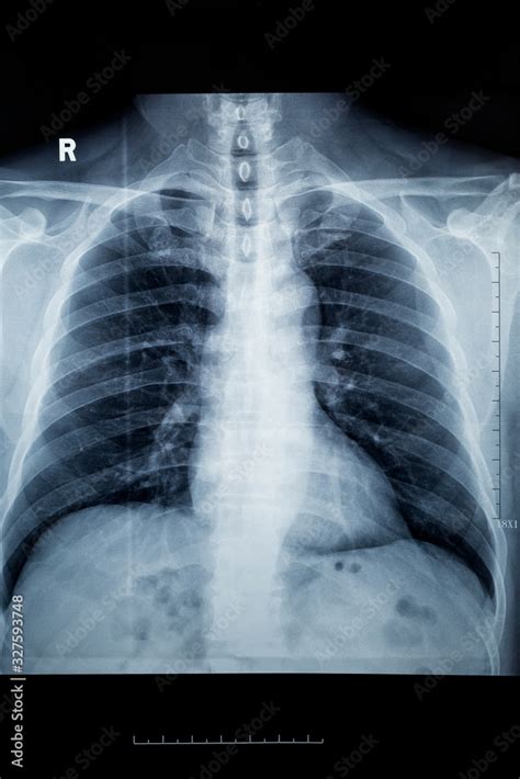 COPD Lung Normal Lungs: What COPD Looks Like, 53% OFF