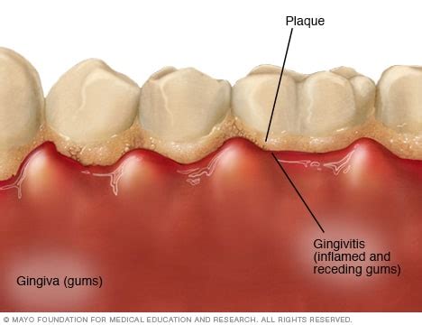 Gingivitis causes symptoms and treatment – Mediologiest