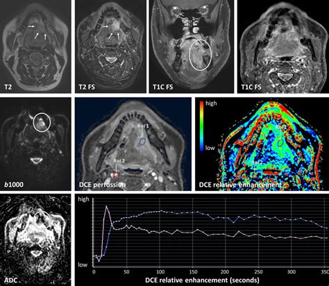 Tumor recurrence differentiated using diffusion and perfusion. A ...