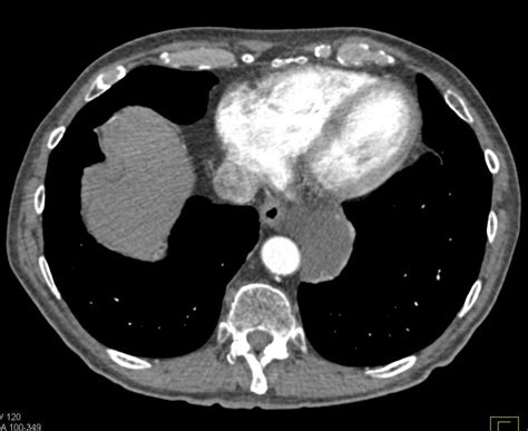 Esophageal Duplication Cyst - Esophagus Case Studies - CTisus CT Scanning