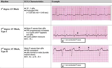 Understanding Ecg Results