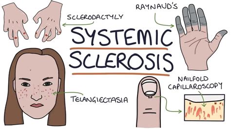 What Treatments are Available for Patients with Systemic Sclerosis ...