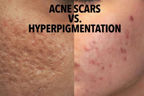 How To Get Rid Of Acne Scars : According To Dermatologists - Cosmetic News