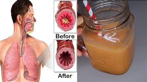 How To Get Rid Of Phlegm In Throat - Sheetfault34