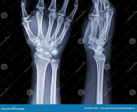 X-ray Image of Wrist Joint for Diagnosis Rheumatoid Arthritis Stock ...