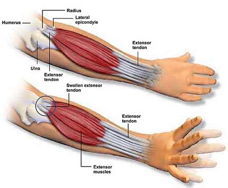 Forearm Pain: A New Treatment For An Old Problem - DRUM! Magazine