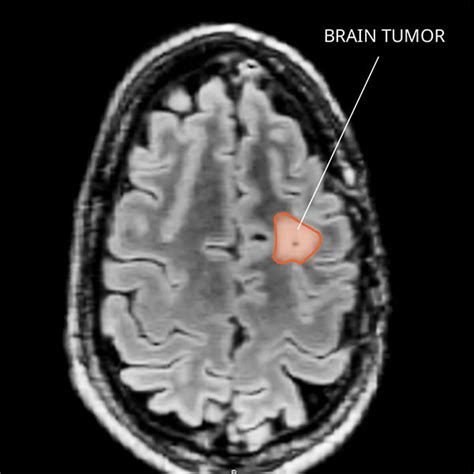 Pleomorphic Xanthoastrocytoma (PXA) and Other BRAF-Altered Tumors ...