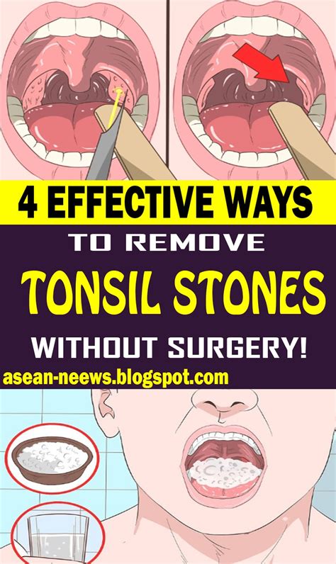 4 EFFECTIVE WAYS TO REMOVE TONSIL STONES WITHOUT SURGERY - HEALTH and ...