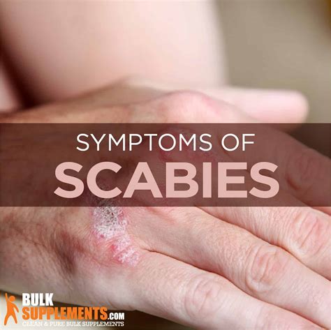 Scabies Rash On Hands