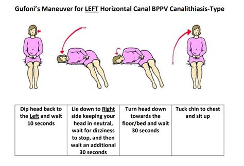 Epley Maneuver Image