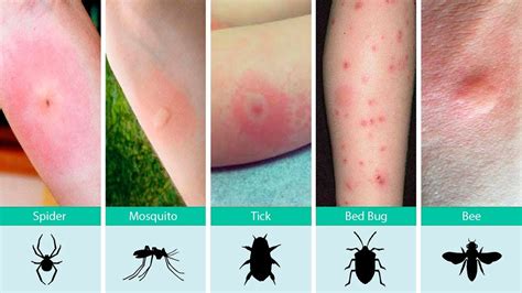 Mosquito Bites Vs Bed Bug Bites