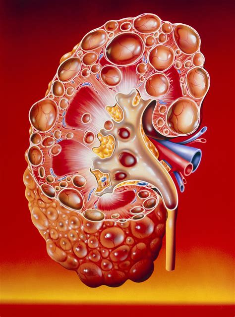 Polycystic Kidney Disease (PKD): The Basics