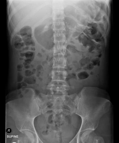 Chronic pancreatitis | Radiology Case | Radiopaedia.org | Radiology ...