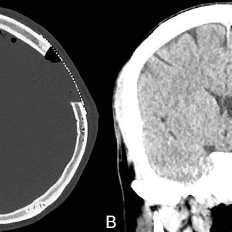 Post-operative imaging. (A and B) Axial and coronal computerised ...