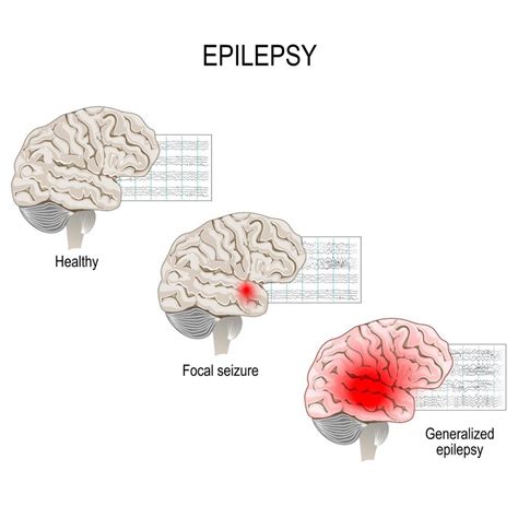 November is National Epilepsy Awareness Month - Premier Neurology ...