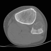 Osteoblastoma | Radiology Reference Article | Radiopaedia.org ...