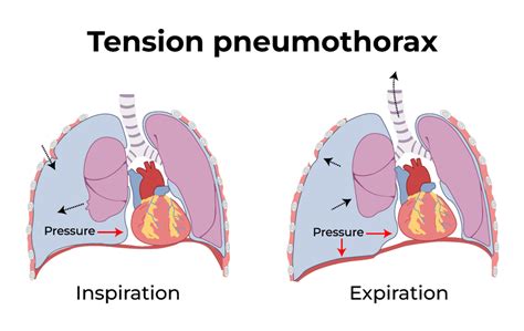 Difference between Pneumothorax and Tension Pneumothorax - GeeksforGeeks