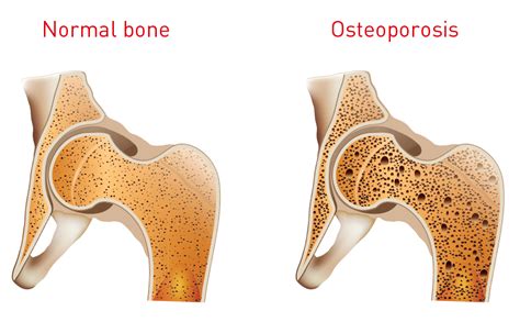 Bone health: Factsheet