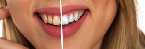 Remedies That You Can Do at Home for Yellow Teeth | by Emma Kalman | Medium