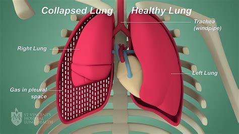 Pneumothorax - St Vincent's Lung Health